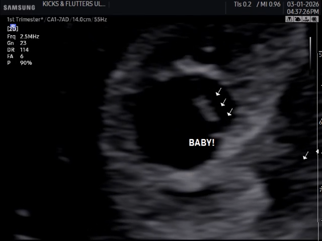 6 week ultrasound scan showing early pregnancy structures